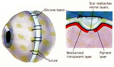 Scleral Buckling